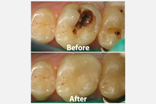 Dental Fillings Before and After Images